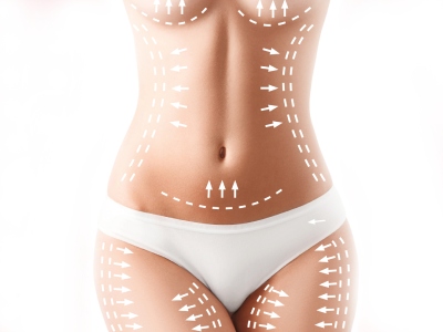 Female torso with plastic surgery markings.