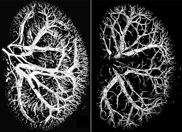 A micro-CT scan showing the blood vessels of healthy (left) and damaged (right) kidneys. (Image courtesy of A. Chade)