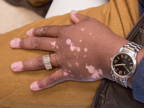 Barron Kaho's vitiligo began with a spot on his forehead but spread to his hands.