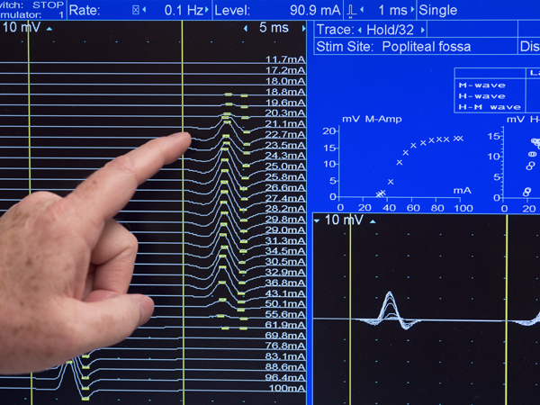 In the MRC electrophysiology labs, waves show muscle response to increasing electrical stimulation from an electrode placed behind a patient's knee.