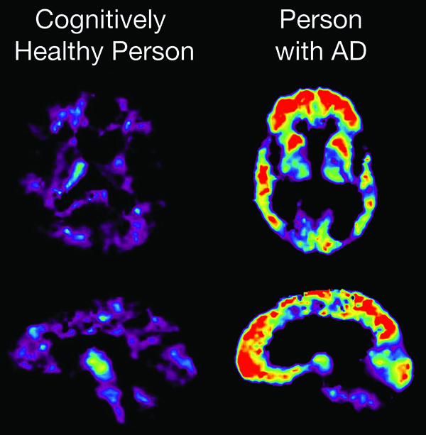 A PET scan reveals brain changes associated with Alzheimer's disease. At right, areas that glow red represent higher concentrations of amyloid plaque. (Image courtesy of the National Institute on Aging)