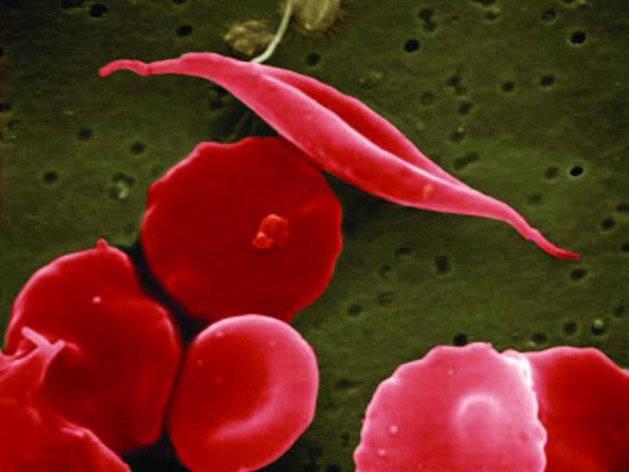 Sickle cell trait and sickle cell disease cause red blood cells to change shape, shown by the top cell. People with sickle cell trait experience llimited sickling and few to no symptoms. (Photo credit: NIH)
