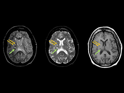 An MRI scan shows infarctions in the brain, marked by arrows.