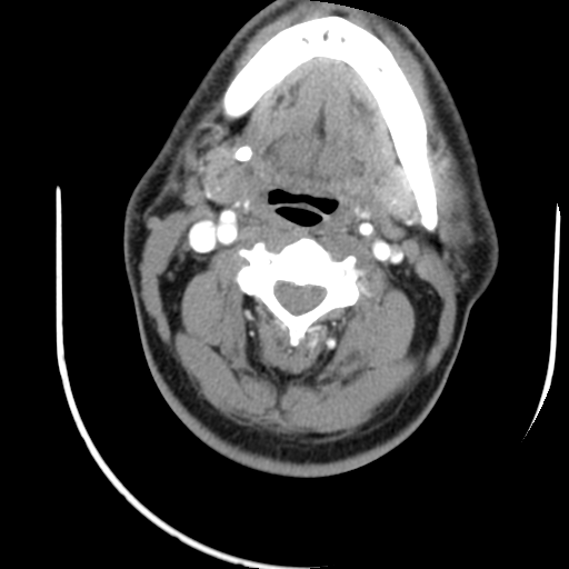 sialendoscopy-1.png