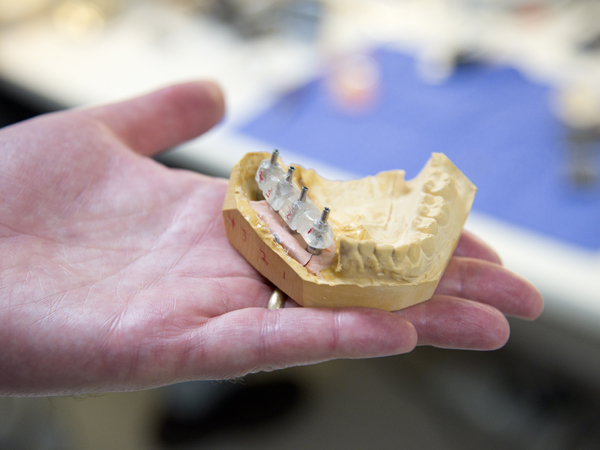 UMMC patients receiving a "Jaw in a Day" procedure come out of surgery with a portion of their jawbone replaced, complete with dental posts and prosthetic teeth on the posts.