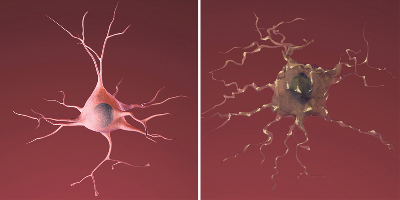 On the left is a healthy neuron. On the right, a neuron damaged by amyloid plaque, a sign of Alzheimer's Disease. (Image credit: National Institute on Aging)