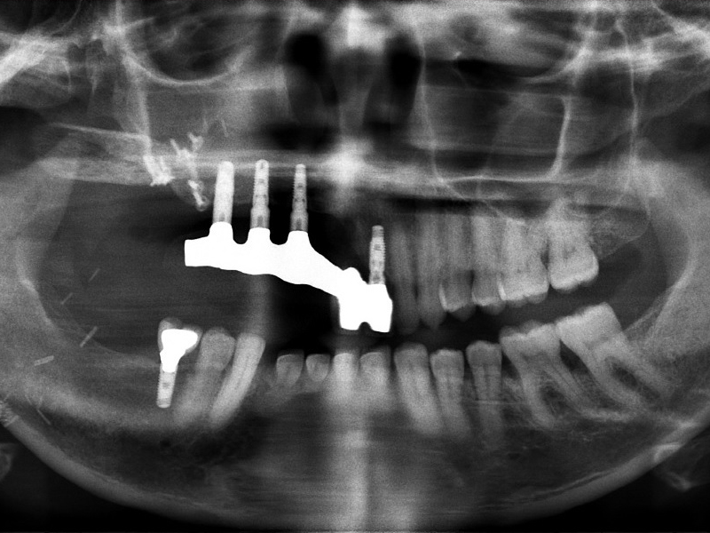 A recent radiograph shows Johnson's upper jaw, rebuilt from a portion of her fibula, and dental implants that replaced the teeth removed with her cancer.