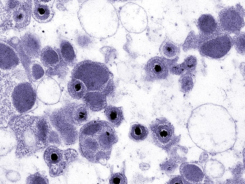 HCMV infection (dark spots) grown in tissue culture (photo credit: CDC)