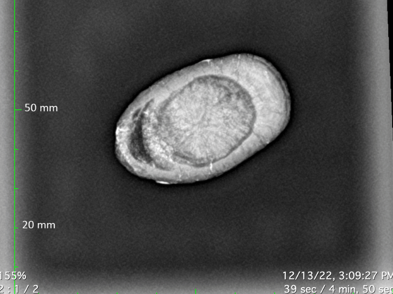 One of the most remarkable discoveries made on the Asylum Hill Project has been a calcified, or "porcelain" gallbladder. This is an X-ray image of the organ identified by Dr. Ralph Didlake, a retired surgeon and the director of the project.