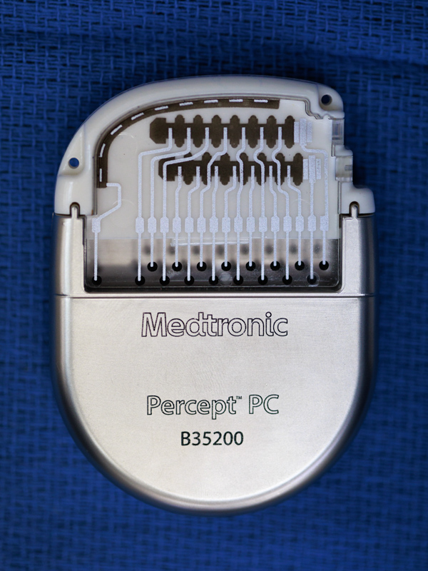 The battery for the deep brain stimulation system is installed in a patient's chest or abdomen and two thin wires connected to the device are run up the spine to the brain.
